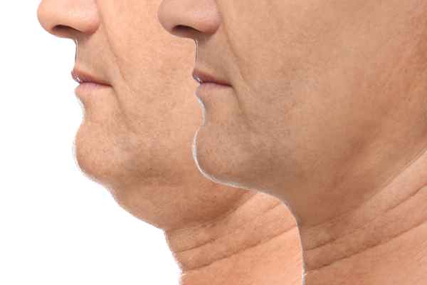 HIFU - Breakthrough in Anti - ageing 2 hifu results Tetbury