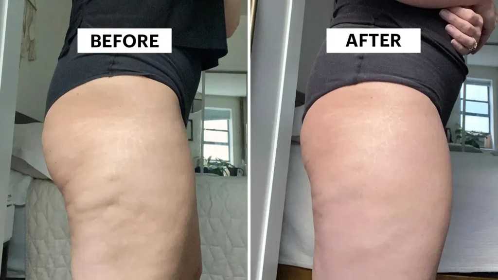 Sculpting Your Bum: Can Toning Exercises Really Reduce Cellulite? 1 Do Toning Exercise Tetbury Really Tackle Cellulite?