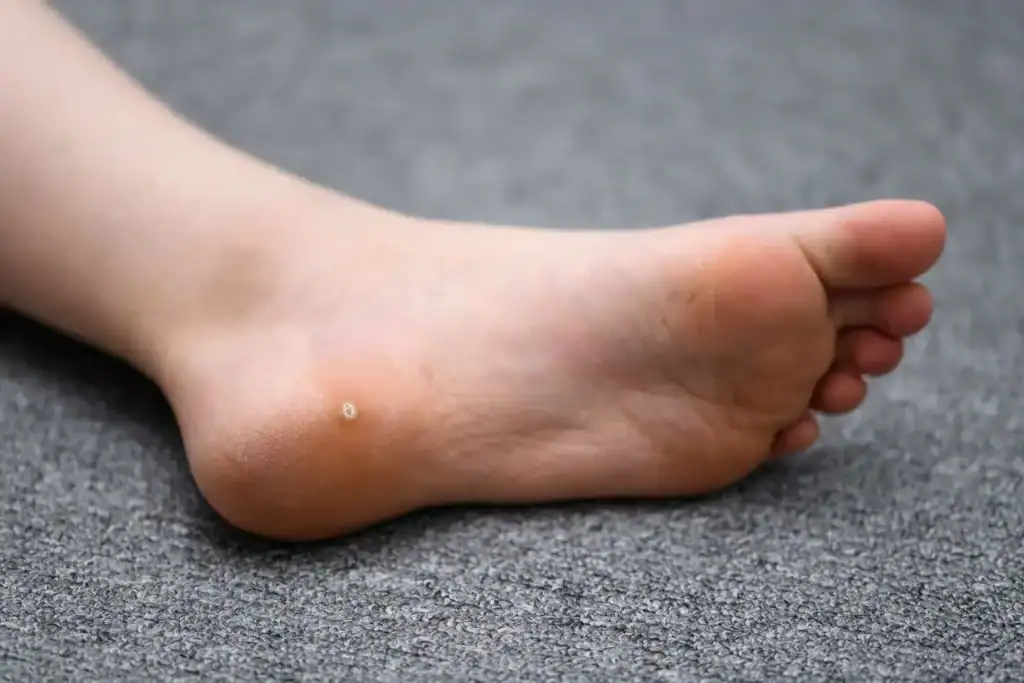 Cryotherapy For Warts And Also Verrucas 2 Image of verruca on the bottom of the foot that able to be treated with Cryotherapy Tetbury