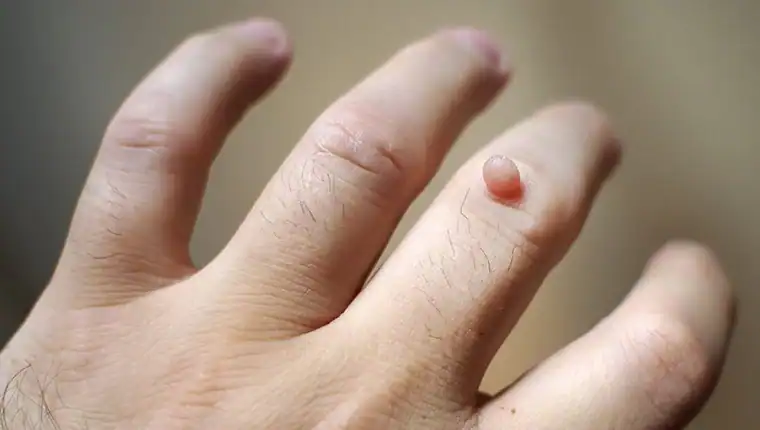 Cryotherapy For Warts And Also Verrucas 1 Image of blemish that Cryotherapy Tetbury can remove with Lipo 360.