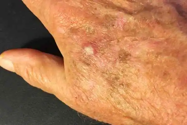 Cryopen For Actinic Keratoses 1 Image of Actinic keratoses Tetbury on a person hand