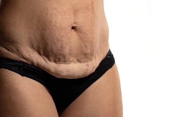 The Science of Skin Tightening 1 The science behind skin tightening Tetbury picture of a woman's sagging skin on the stomach